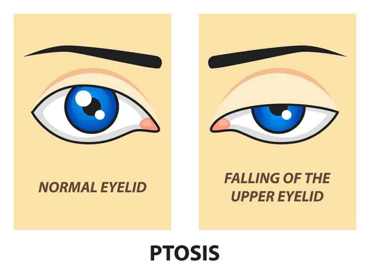 What is Ptosis? Causes, Symptoms, and Treatment Options